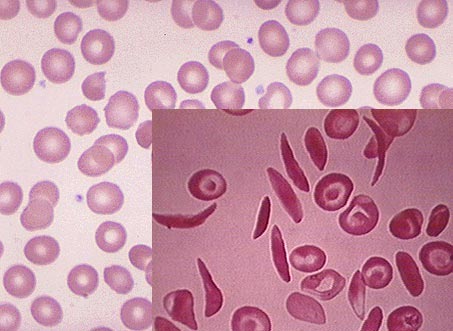  A photo shows magnified red blood cells.